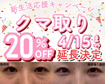 【キャンペーン期間延長決定🎊】クマ取り20％OFFキャンペーン開催中✨クマ取りするなら湘南美容クリニック水戸院へ🩵
